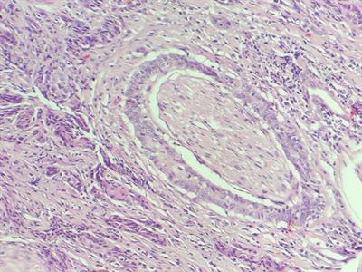 Perineural invasion as a predictor of local recurrence in cats with squamous cell carcinoma treated with electrochemotherapy